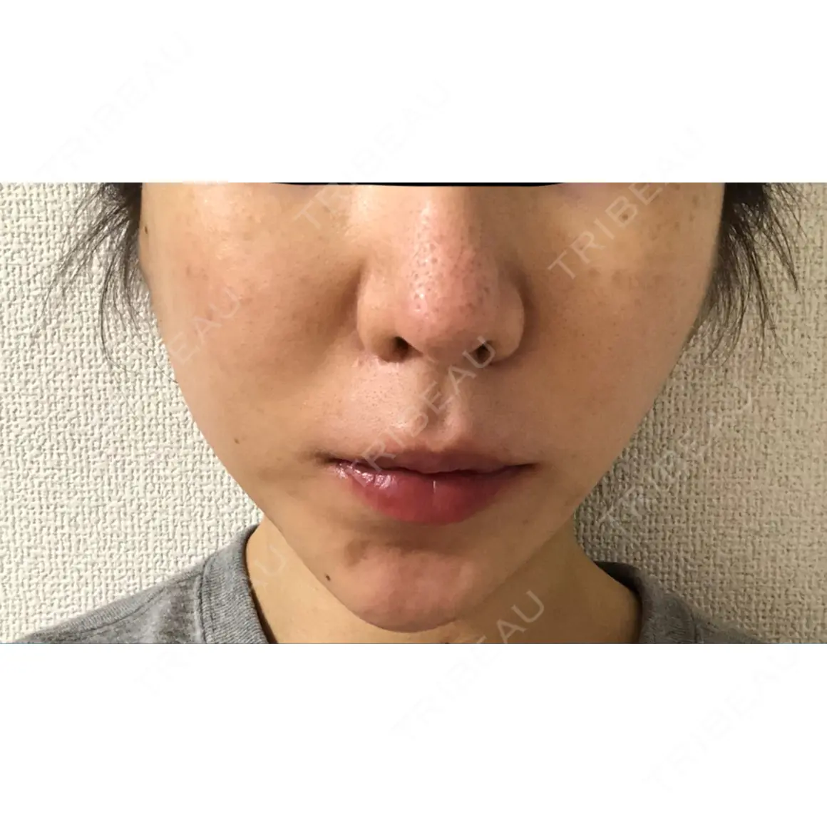 糸リフト ノーチェビューティクリニック DAY 0