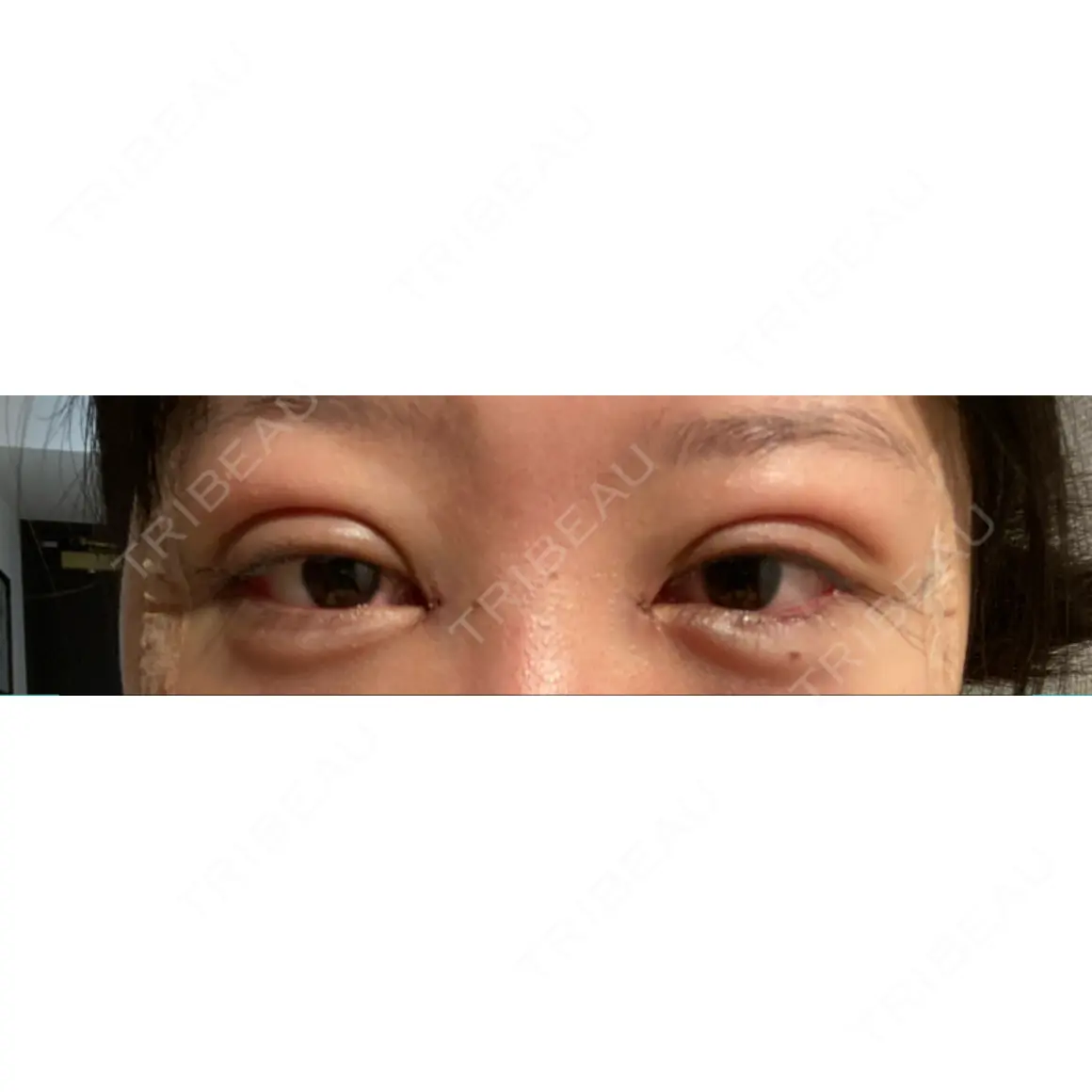 二重埋没 / 目頭切開 / 目尻切開 / タレ目形成・グラマラスライン（切開） HAAB×DREAM BEAUTY CLINIC 東京本院 DAY 0