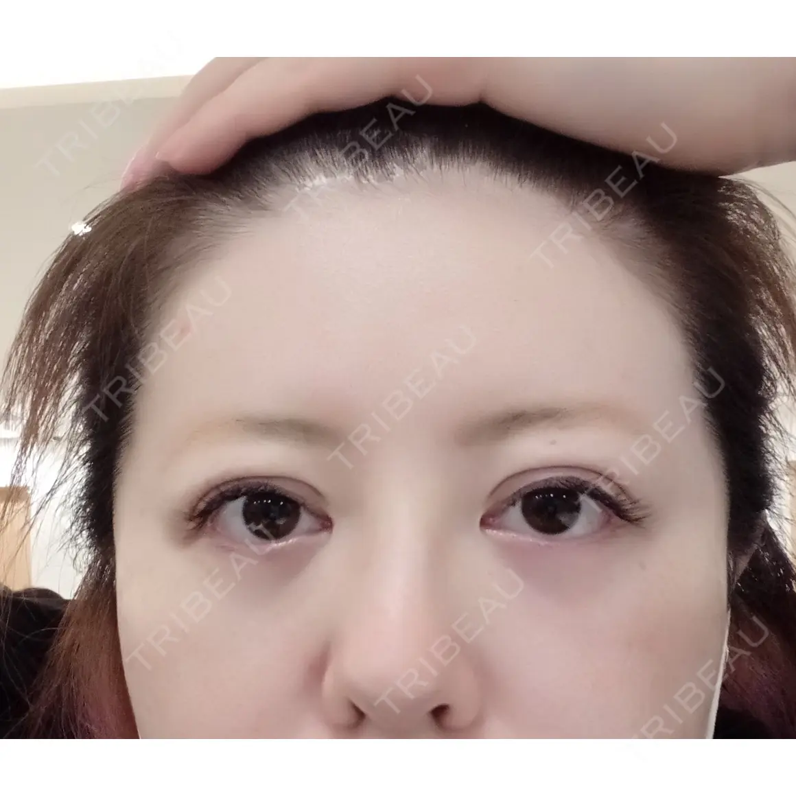二重埋没 湘南美容クリニック 新宿本院 AFTER