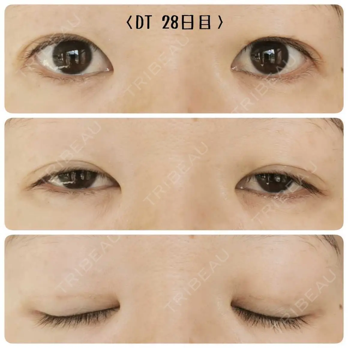 二重埋没 さくら美容外科 AFTER