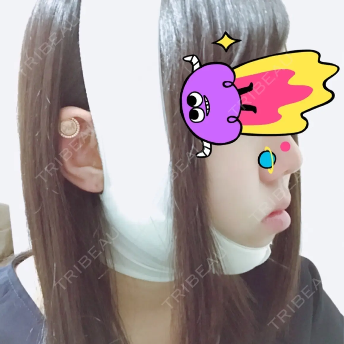 脂肪吸引（顔） 湘南美容クリニック 大阪あべの院 DAY 0