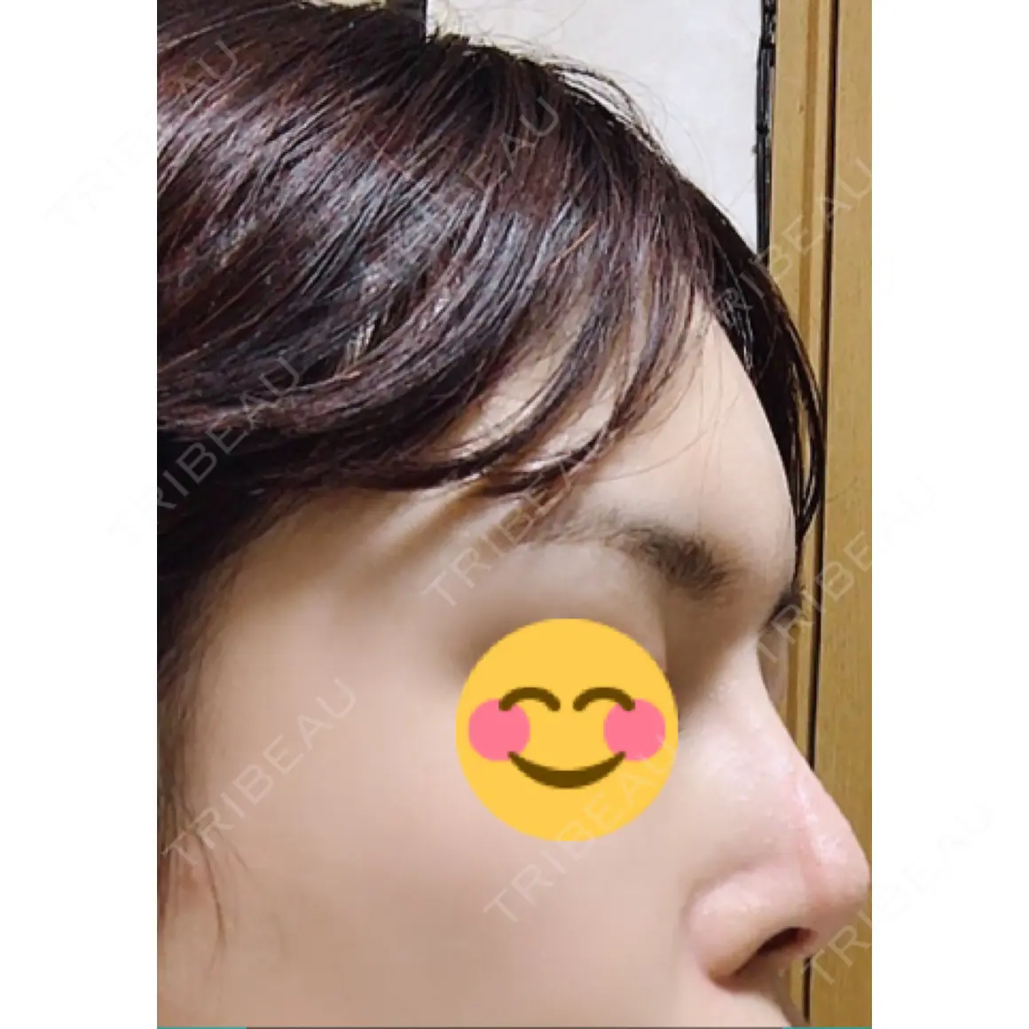 額を丸く / その他（輪郭） 品川美容外科 静岡院 AFTER