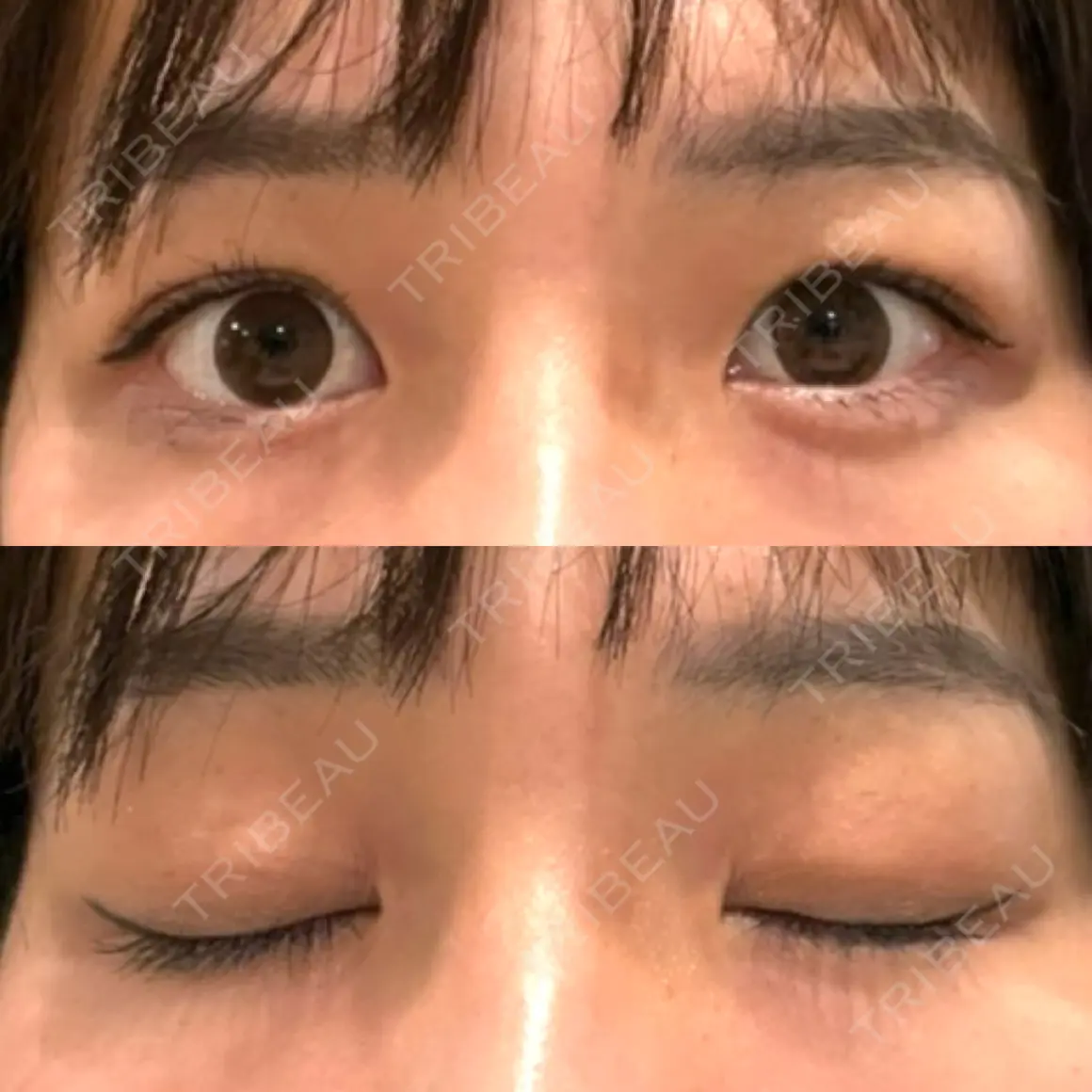 二重埋没 水の森美容クリニック 東京銀座院 AFTER