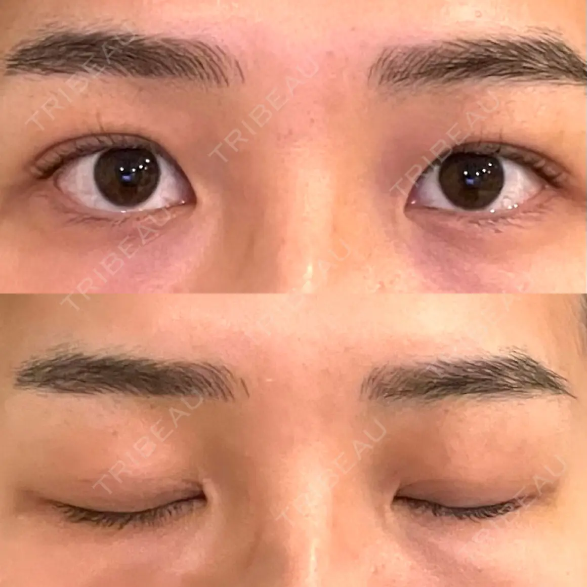 二重埋没 水の森美容クリニック 東京銀座院 AFTER