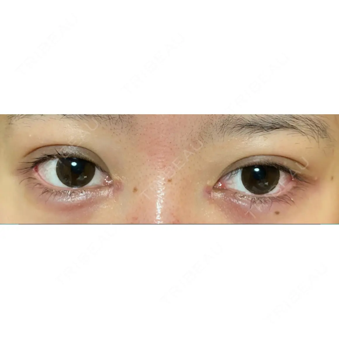 二重埋没 / 目頭切開 / 目尻切開 / タレ目形成・グラマラスライン（切開） HAAB×DREAM BEAUTY CLINIC 東京本院 AFTER