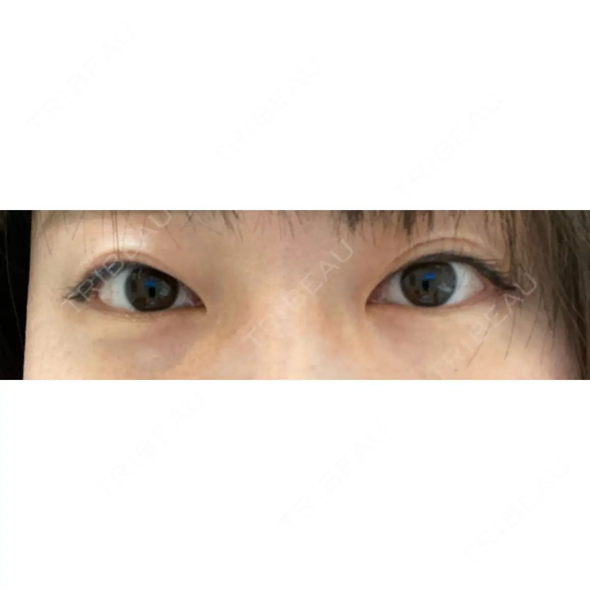 眼瞼下垂（切開） くさのたろうクリニック AFTER