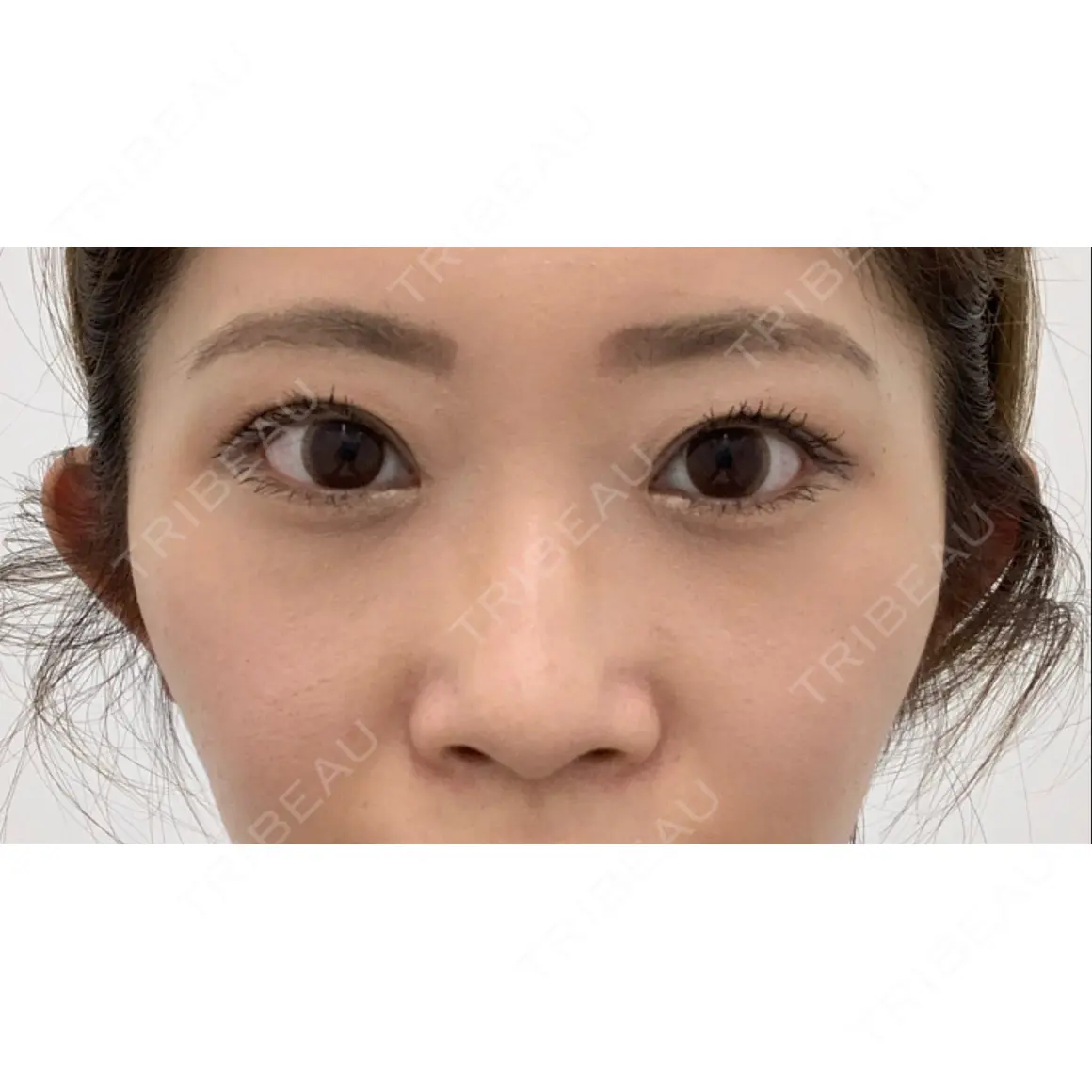 二重切開 / 目頭切開 / 眼瞼下垂（切開） / 上まぶたたるみ取り 湘南美容クリニック 高田馬場院 AFTER