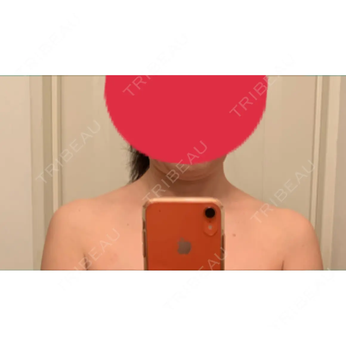 ボトックス（肩） 湘南美容クリニック 藤沢院 DAY 0