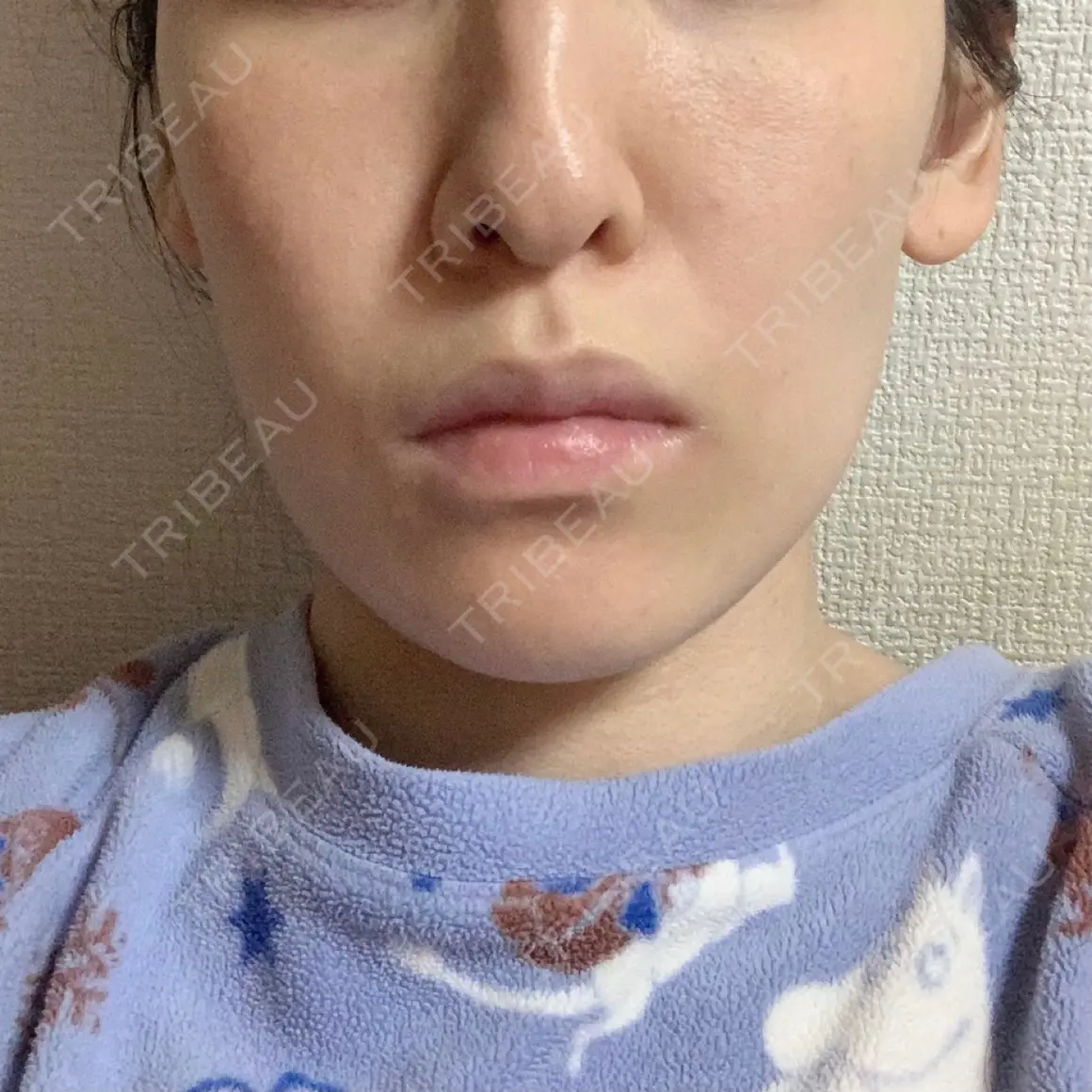 ハイフ（顔） 東京美容皮膚科CLINIC DAY 0