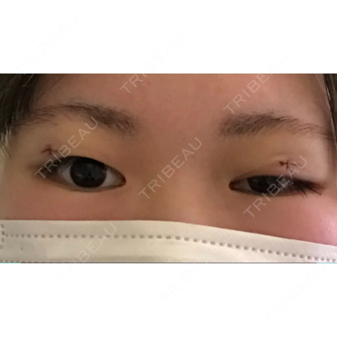 上まぶたの脂肪取り 大塚美容形成外科 札幌院 DAY 0