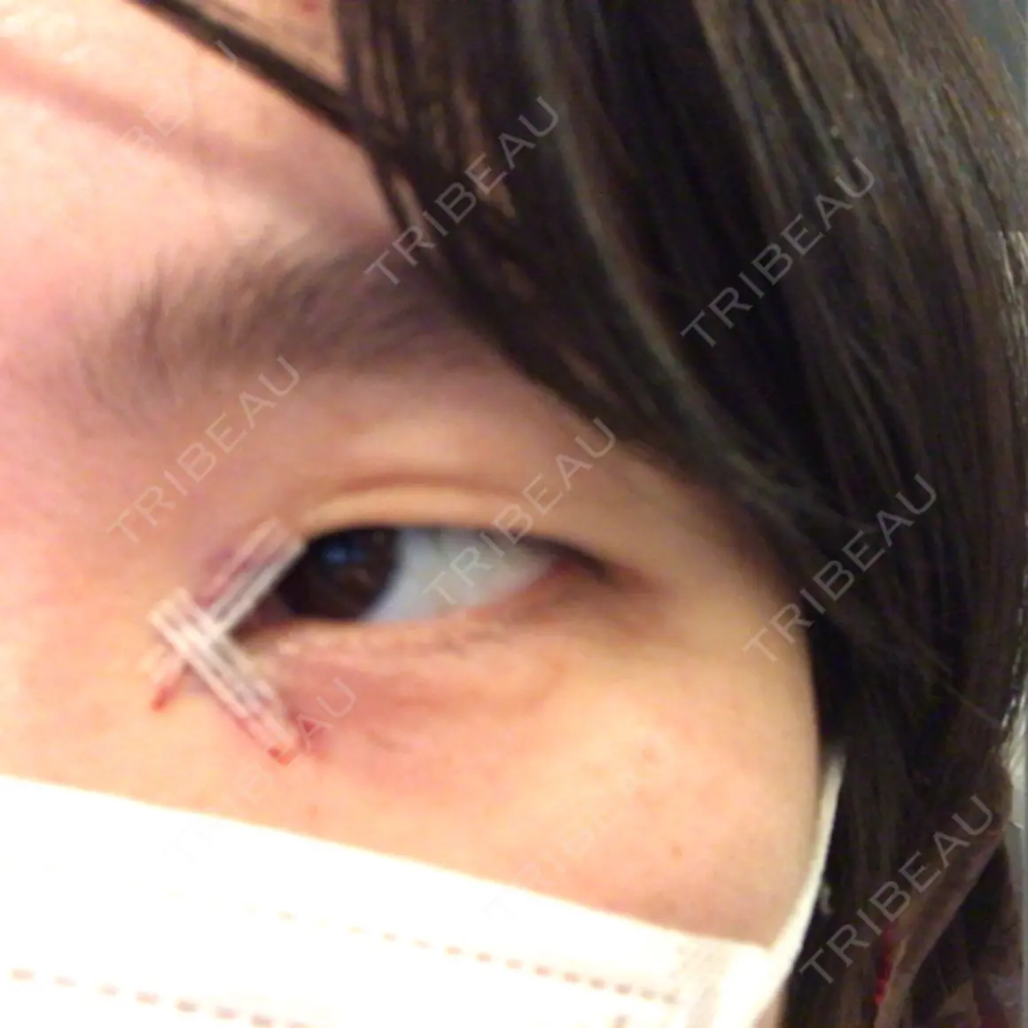 目頭切開 品川美容外科 新宿院（※品川スキンクリニック提携） DAY 0