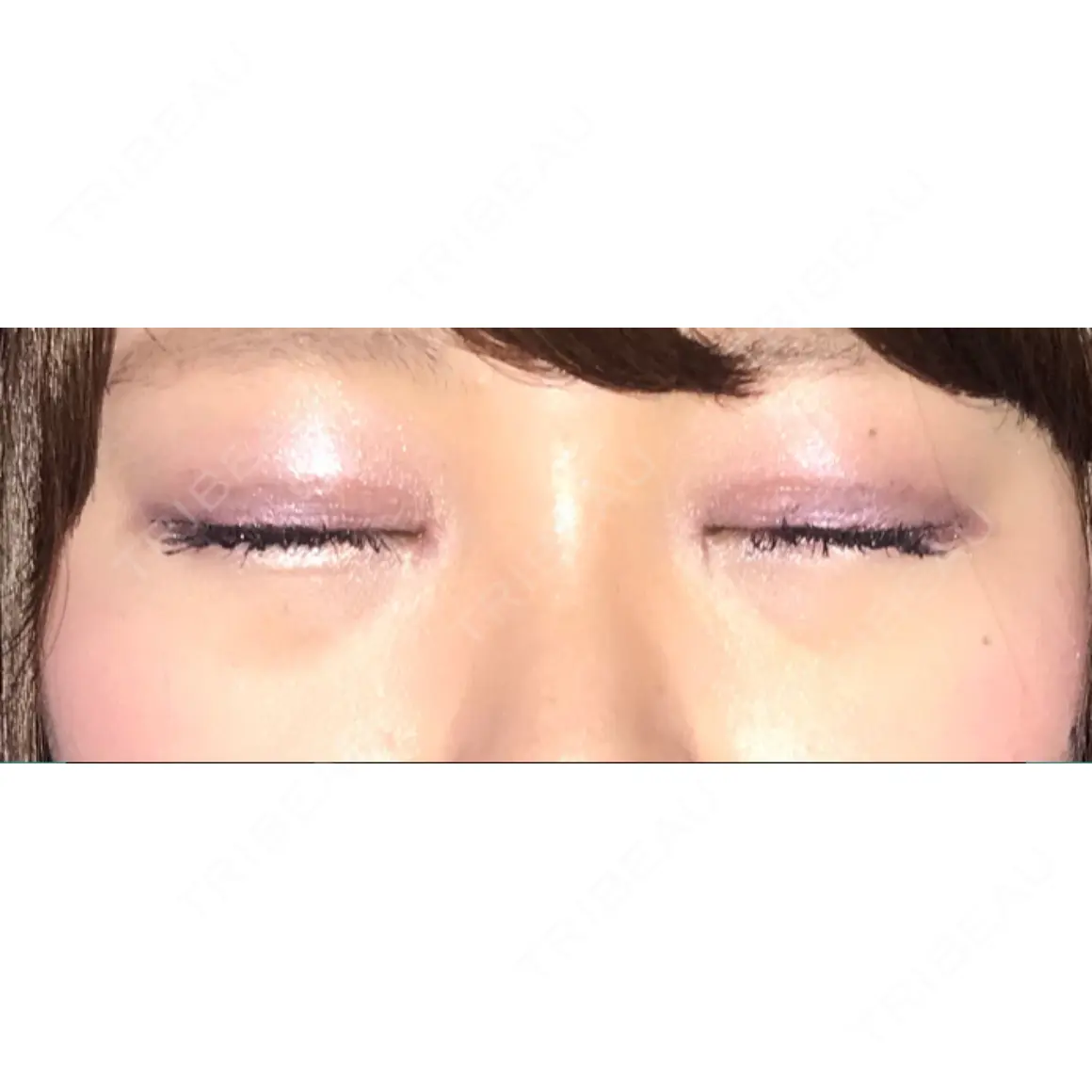 二重埋没 / 目頭切開 / ヒアルロン酸注入（涙袋） 湘南美容クリニック 橋本院 AFTER