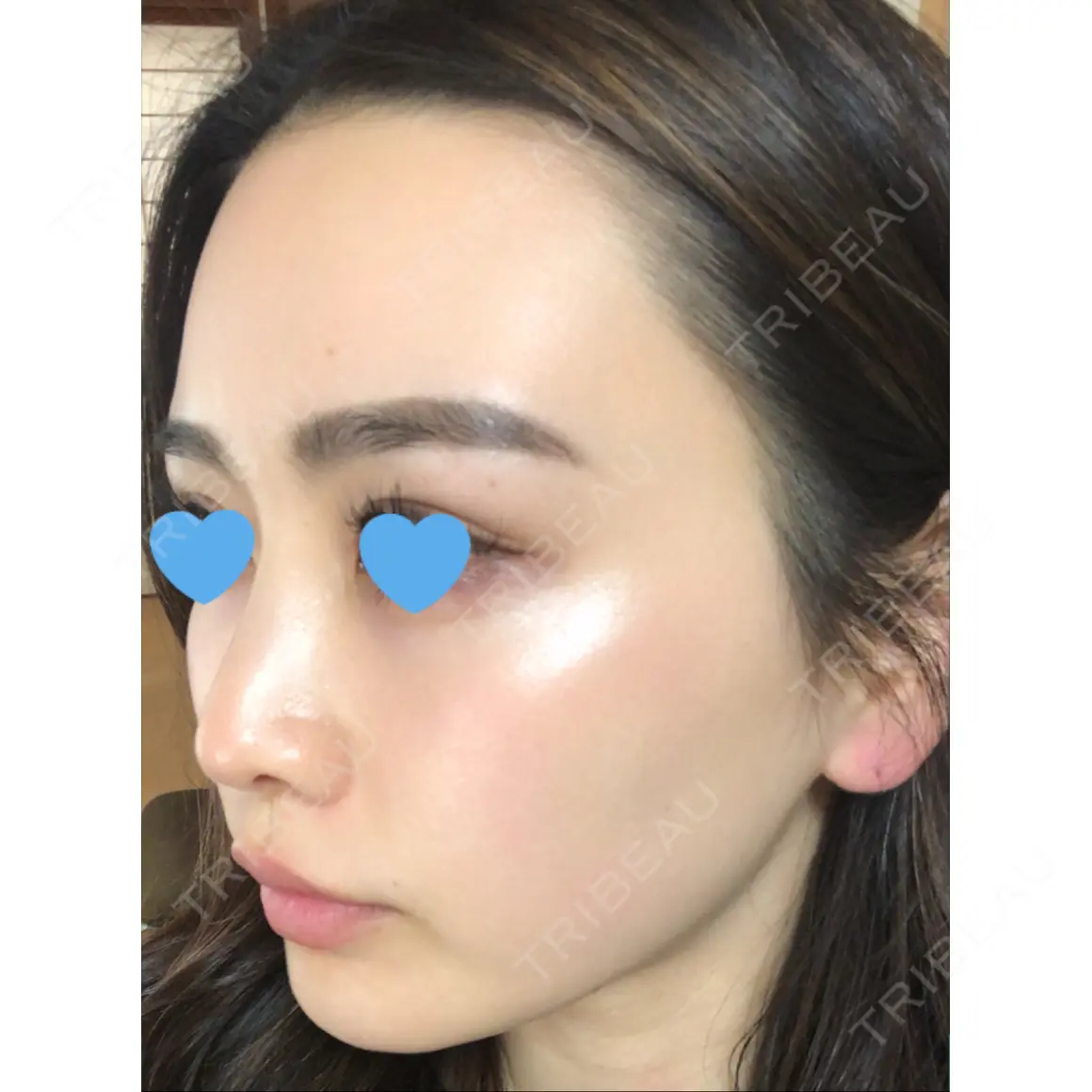 隆鼻術 / 鼻中隔延長（切開） / 脂肪吸引（顔） / 額を丸く / 軟骨移植 / 眉間プロテーゼ / こめかみ形成 / 鼻尖縮小 / 脂肪注入（額） 湘南美容クリニック 新宿本院 AFTER