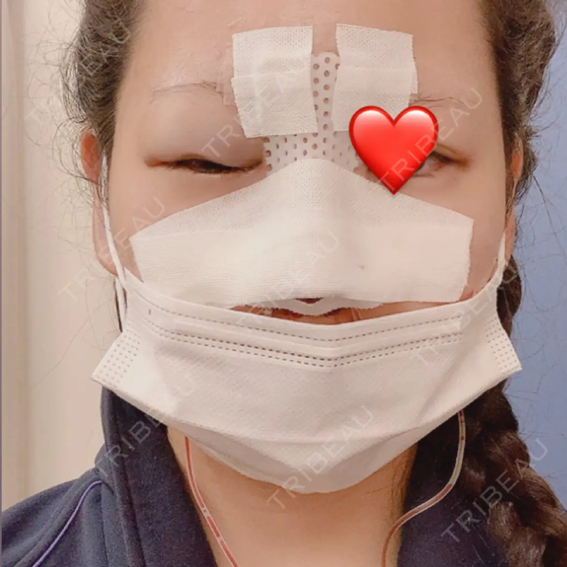 隆鼻術 / 鼻中隔延長（切開） / 眉間プロテーゼ プリモ麻布十番クリニック DAY 0