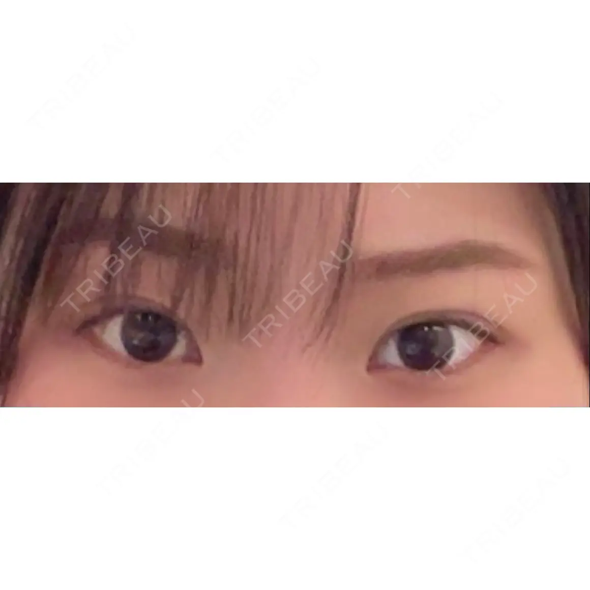 二重埋没 / ボトックス（タレ目） 水の森美容クリニック 東京銀座院 AFTER