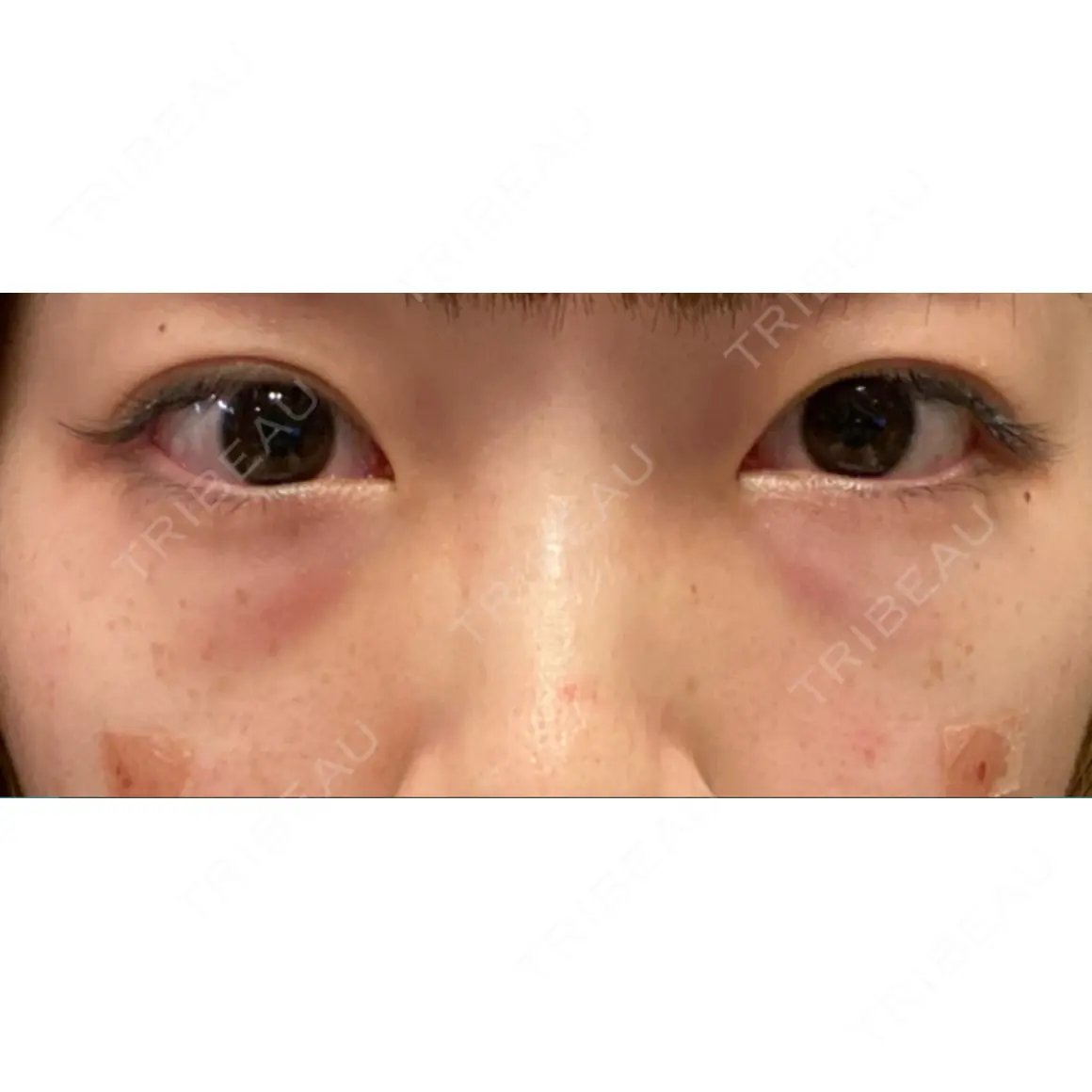 クマ治療 / 下まぶたの脂肪取り セオリークリニック DAY 0