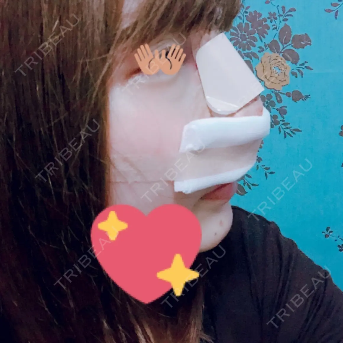 隆鼻術 / 鼻尖形成（切開） / 鼻中隔延長（切開） / 骨切幅寄せ FROM B整形外科 (旧バウム整形外科) DAY 0