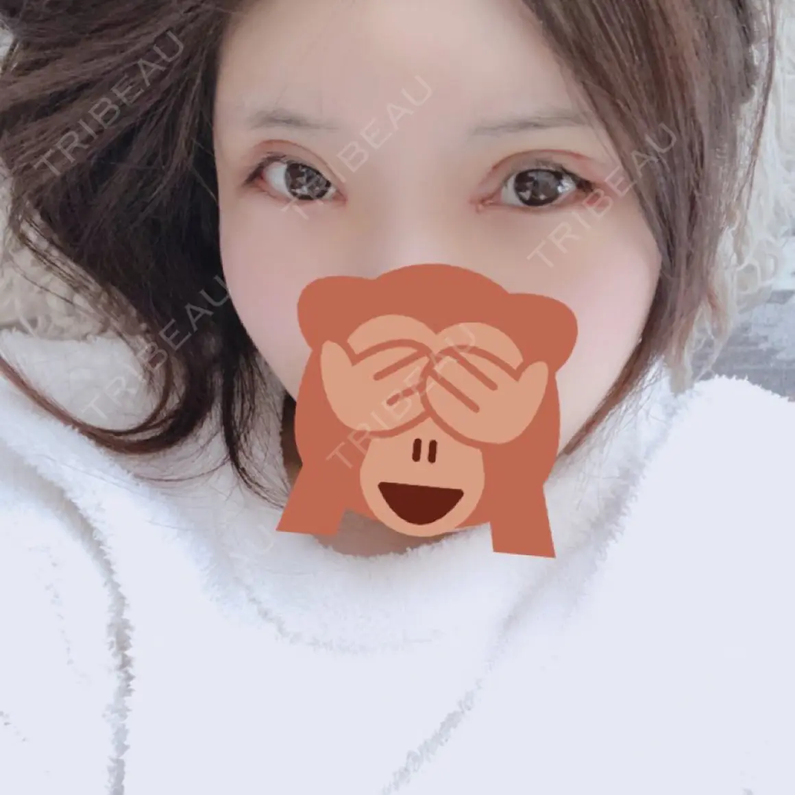 目頭切開 / 眼瞼下垂（切開） 恵聖会クリニック 心斎橋院 DAY 6