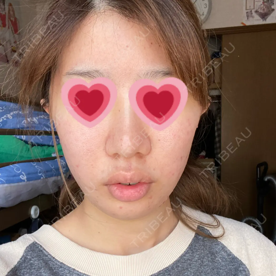 糸リフト / 脂肪吸引（顔） あつぎ美容クリニック DAY 0