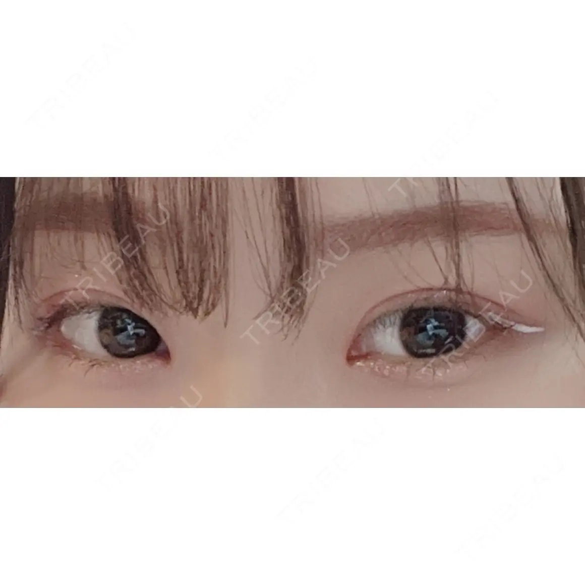 二重埋没 / ボトックス（タレ目） 水の森美容クリニック 東京銀座院 AFTER