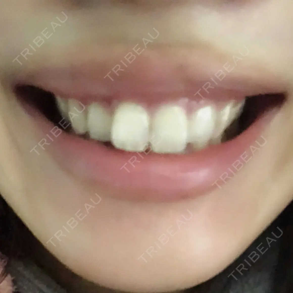 ガミースマイル手術 有楽町美容外科クリニック AFTER