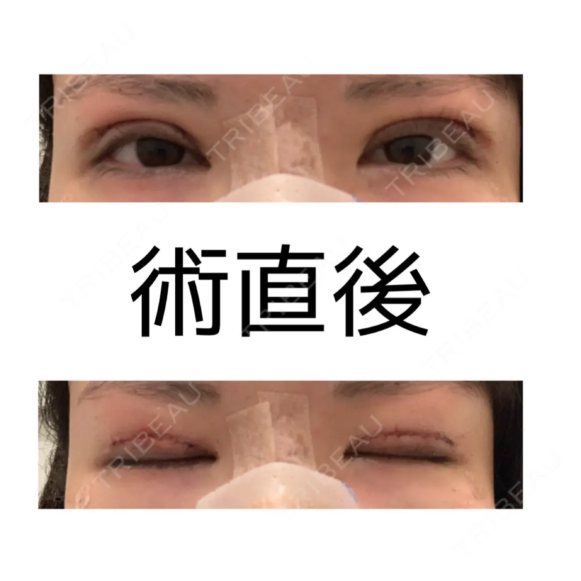 二重切開 eクリニック 金沢本院 DAY 0
