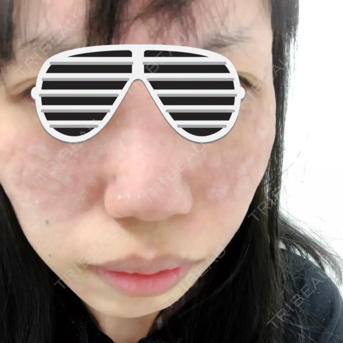 シミ取りレーザー 仁愛クリニック DAY 0