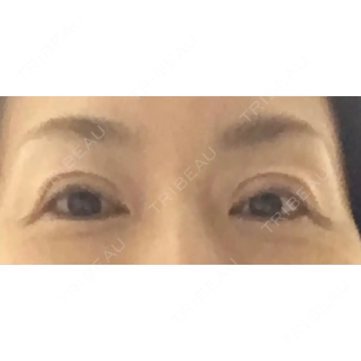 眼瞼下垂（切開） アンジュール横浜クリニック AFTER