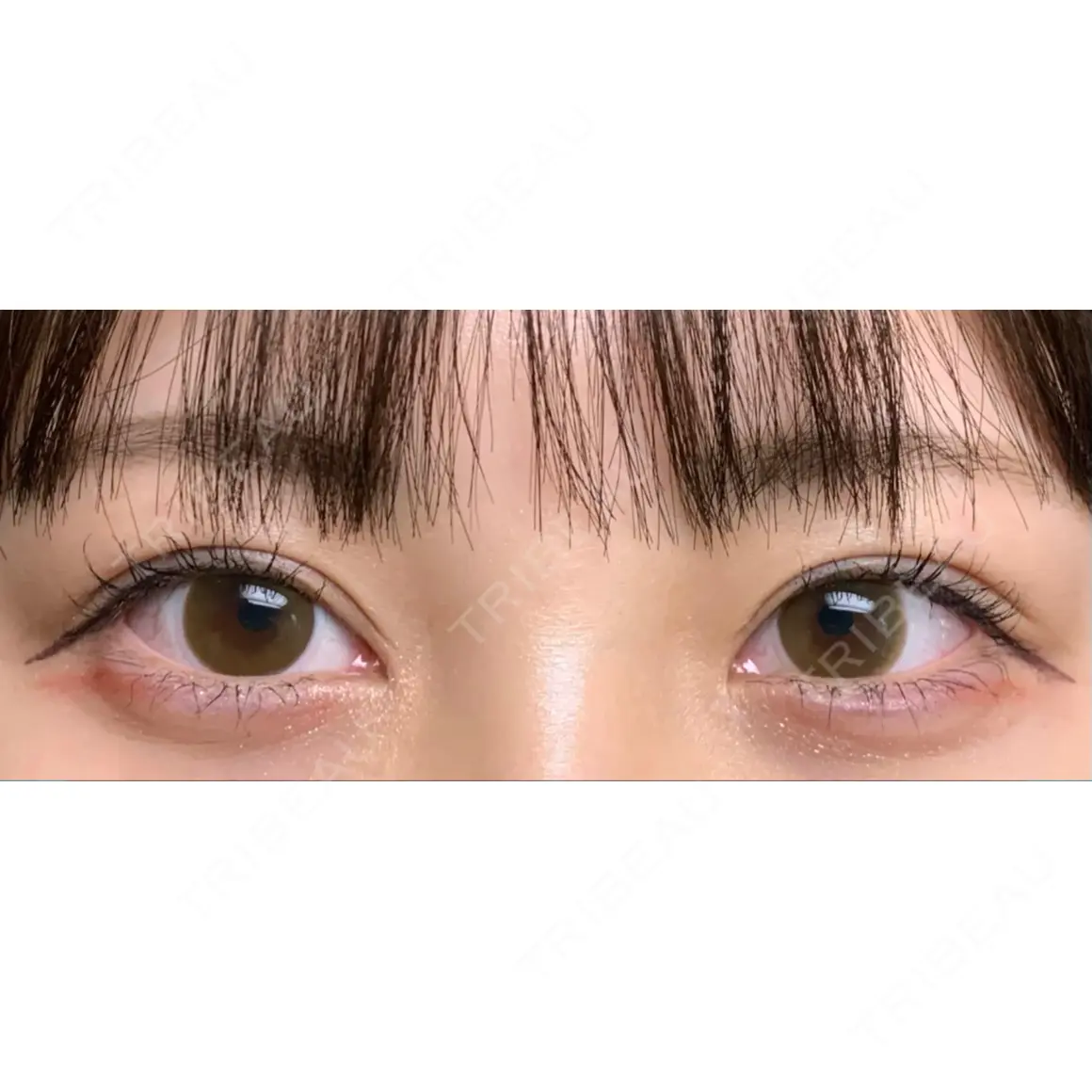 二重切開 / 目頭切開 サラ美容外科 AFTER