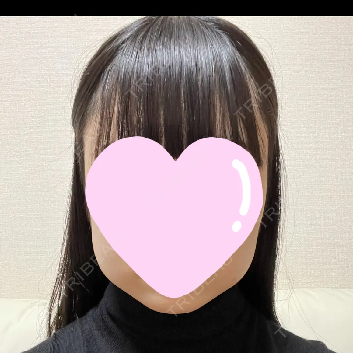 脂肪溶解注射（顔） 東京ロイヤルクリニック DAY 0