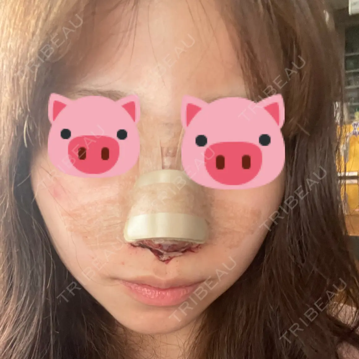 隆鼻術 / 鼻尖形成（切開） / 鼻中隔延長（切開） / 小鼻縮小（切開） / 軟骨移植 グローバルビューティークリニック 大阪院 DAY 0