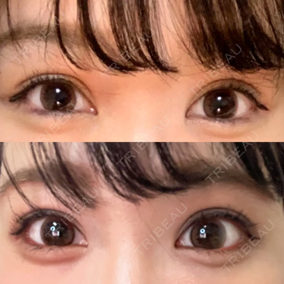 上まぶたの脂肪取り / 眉下切開 WOM CLINIC GINZA （ワム クリニック ギンザ） AFTER