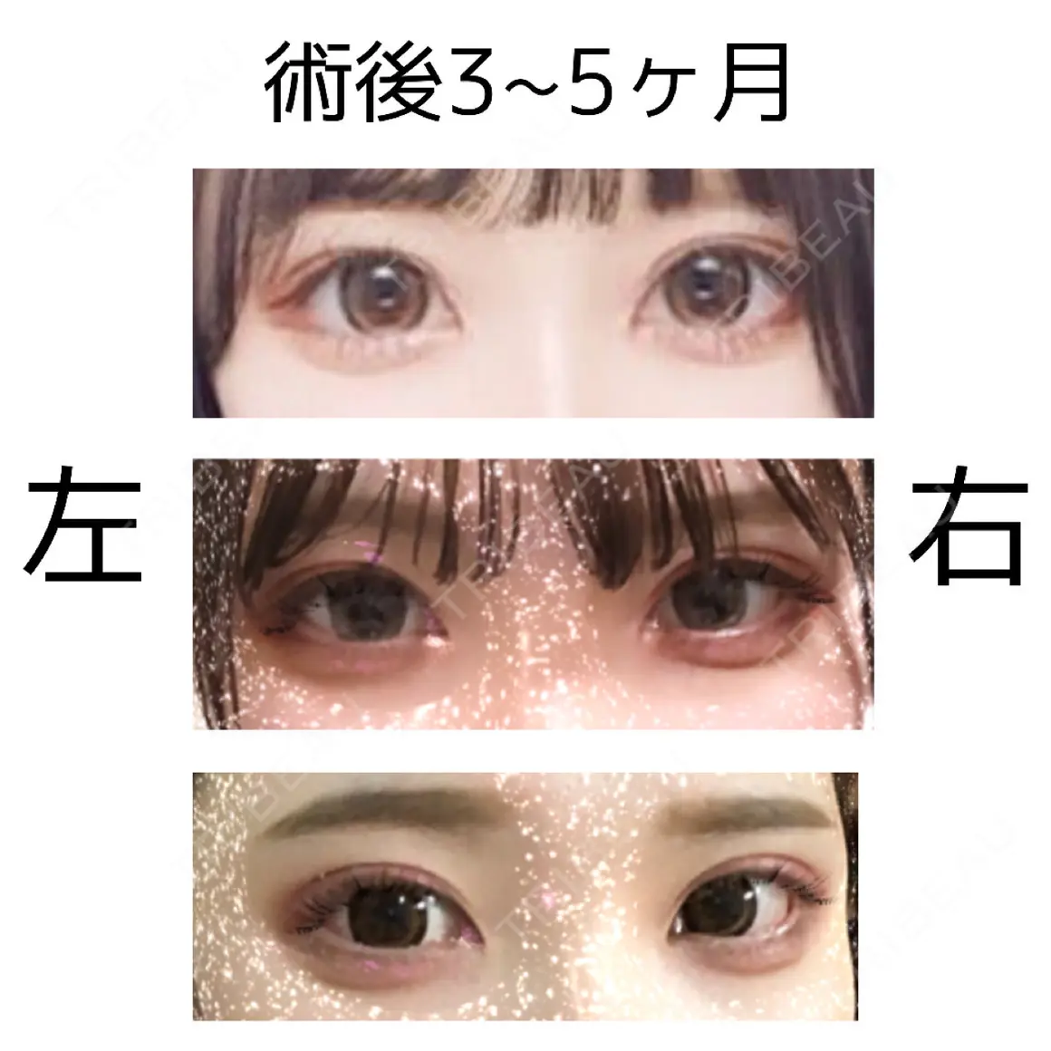 二重埋没 共立美容外科 大宮院 AFTER