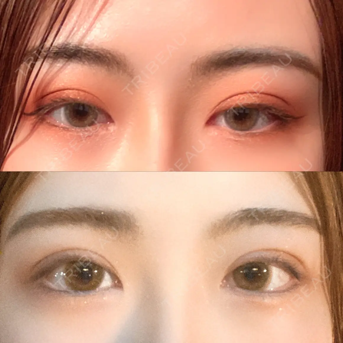 二重埋没 / 目頭切開 / 眼瞼下垂（切開） / タレ目形成・グラマラスライン（切開） / 目元修正 / その他（目元） シナジー整形外科 AFTER