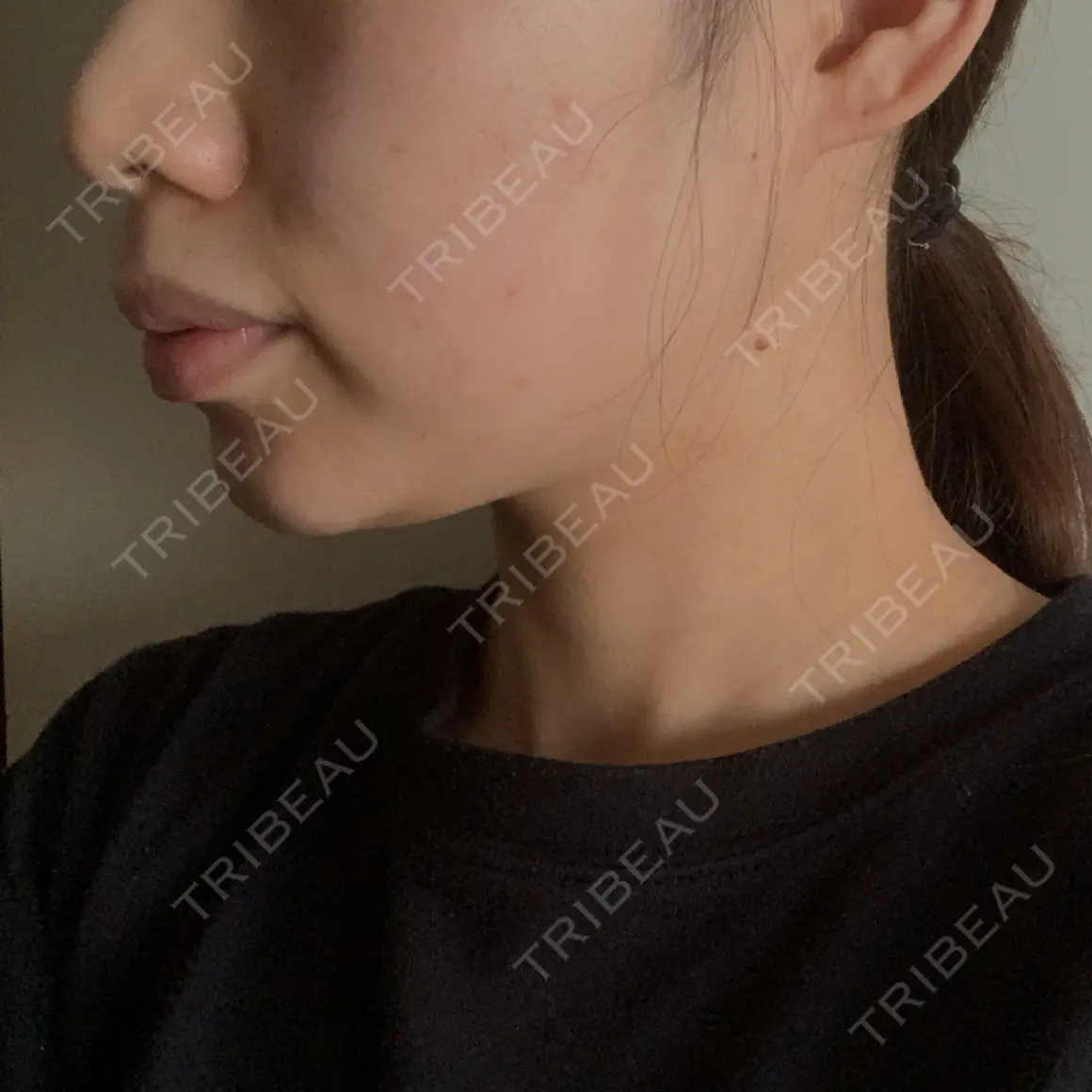 脂肪溶解注射（顔） 湘南美容クリニック 札幌院 AFTER