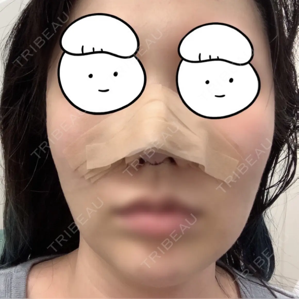 鼻尖形成（切開） / 鼻中隔延長（切開） / 軟骨移植 MIL CLINIC OSAKA DAY 0