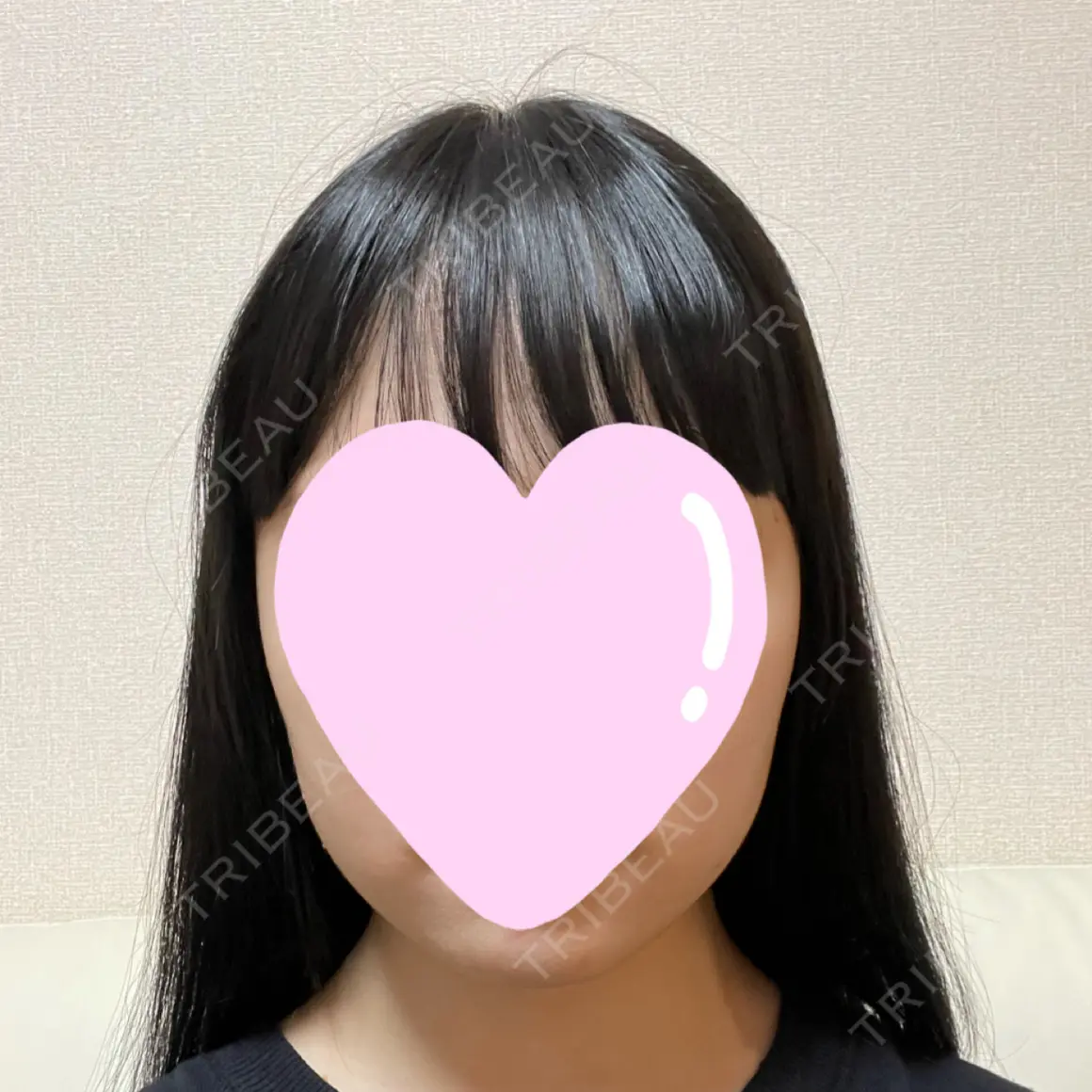 脂肪溶解注射（顔） 東京ロイヤルクリニック AFTER