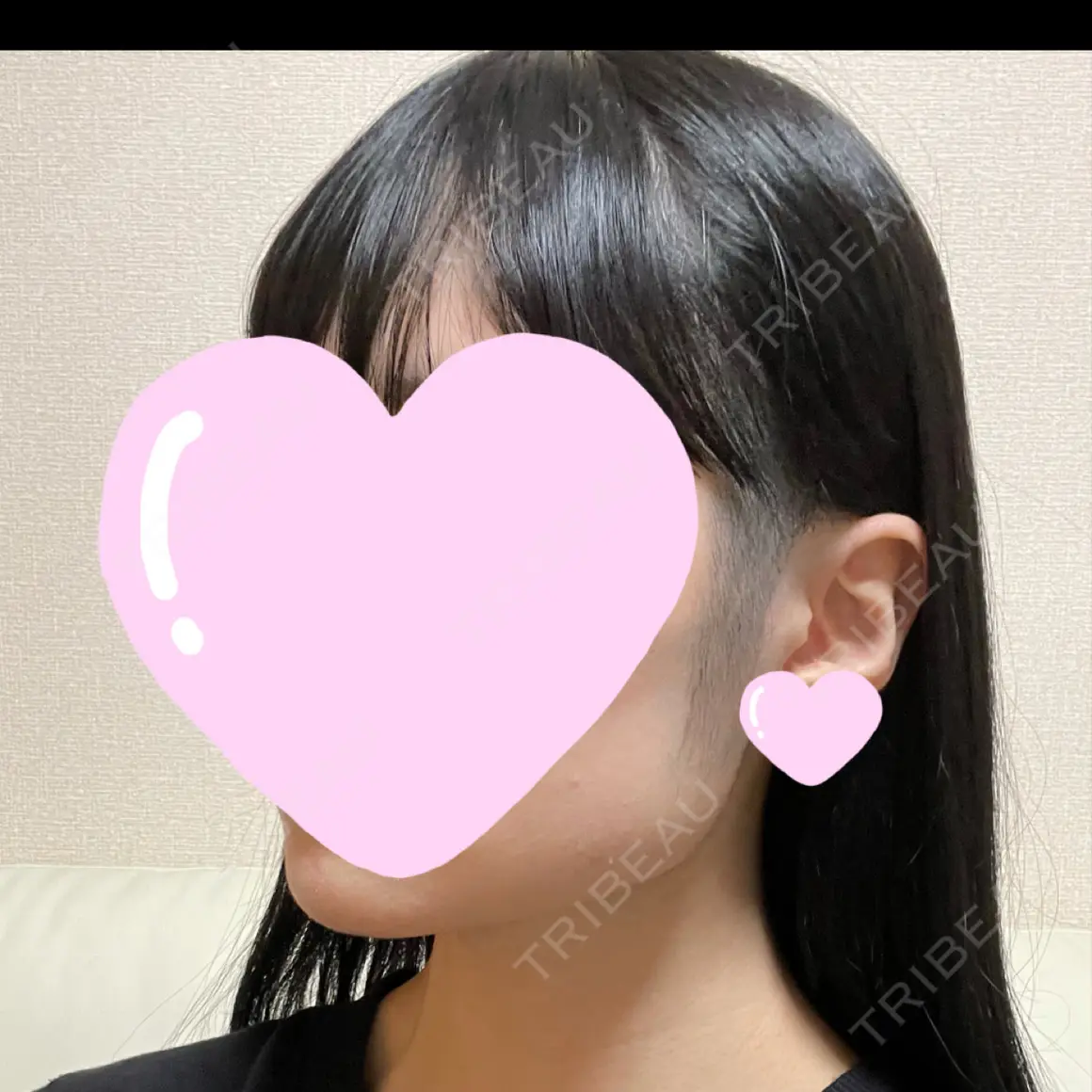 脂肪溶解注射（顔） 東京ロイヤルクリニック AFTER