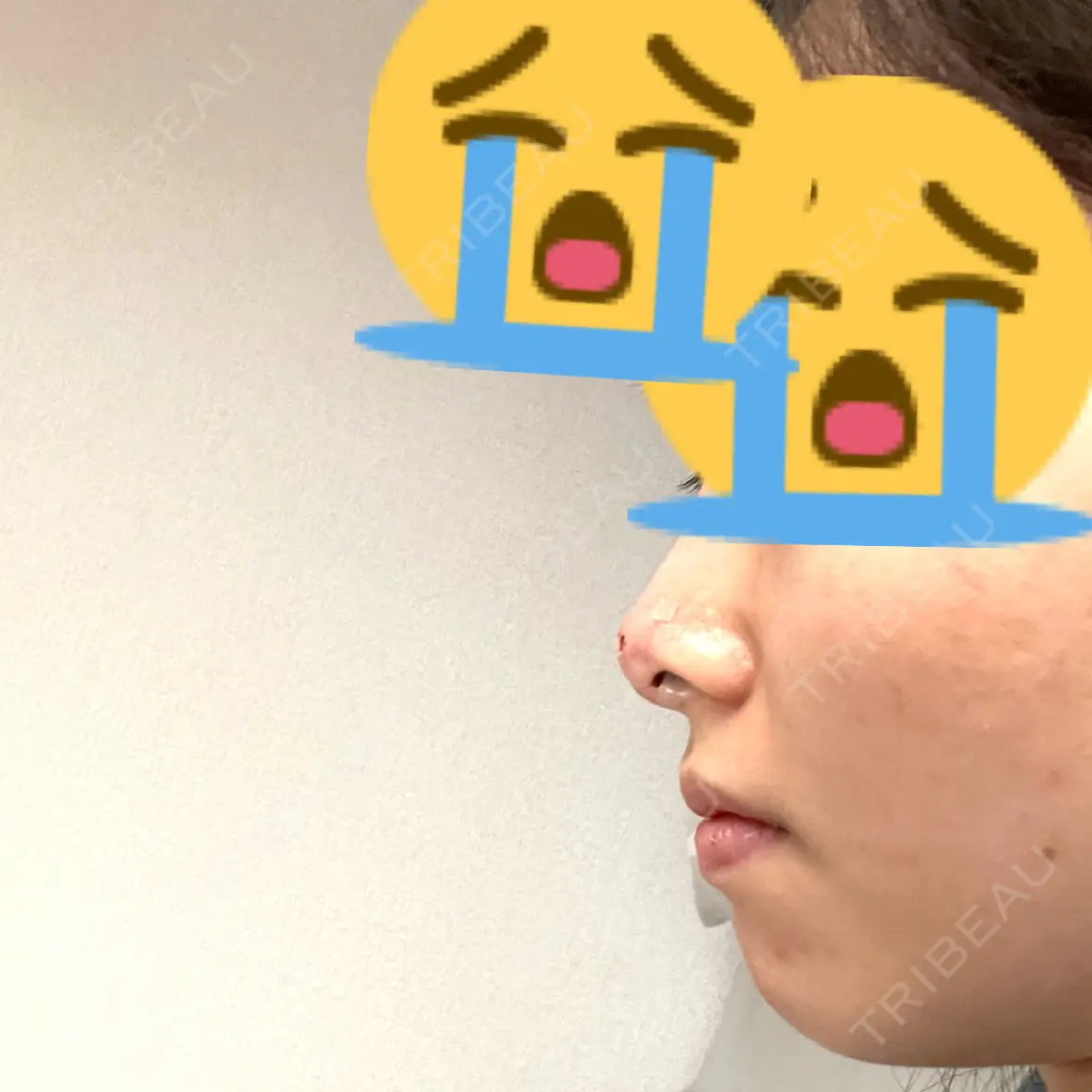 隆鼻術 / 鼻尖縮小 / ヒアルロン酸注入（鼻） 品川美容外科 福岡院 DAY 0