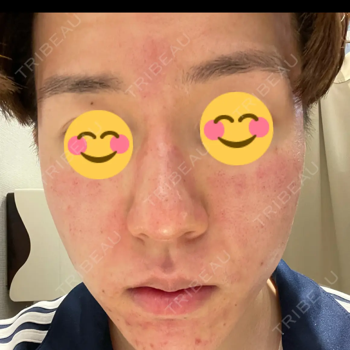 ダーマペン 湘南美容クリニック 高崎院 DAY 0