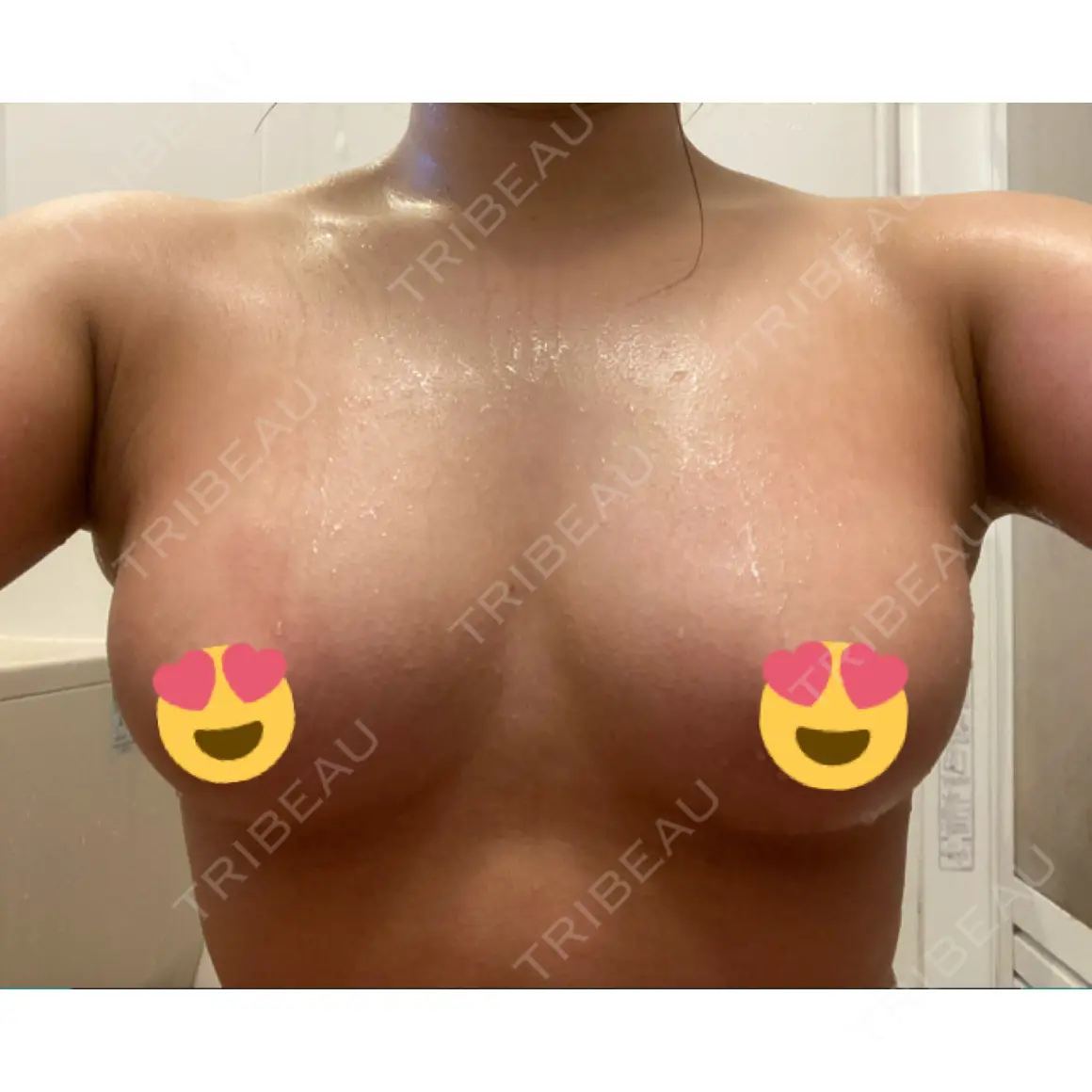 豊胸（脂肪注入） 湘南美容クリニック 新潟院 AFTER
