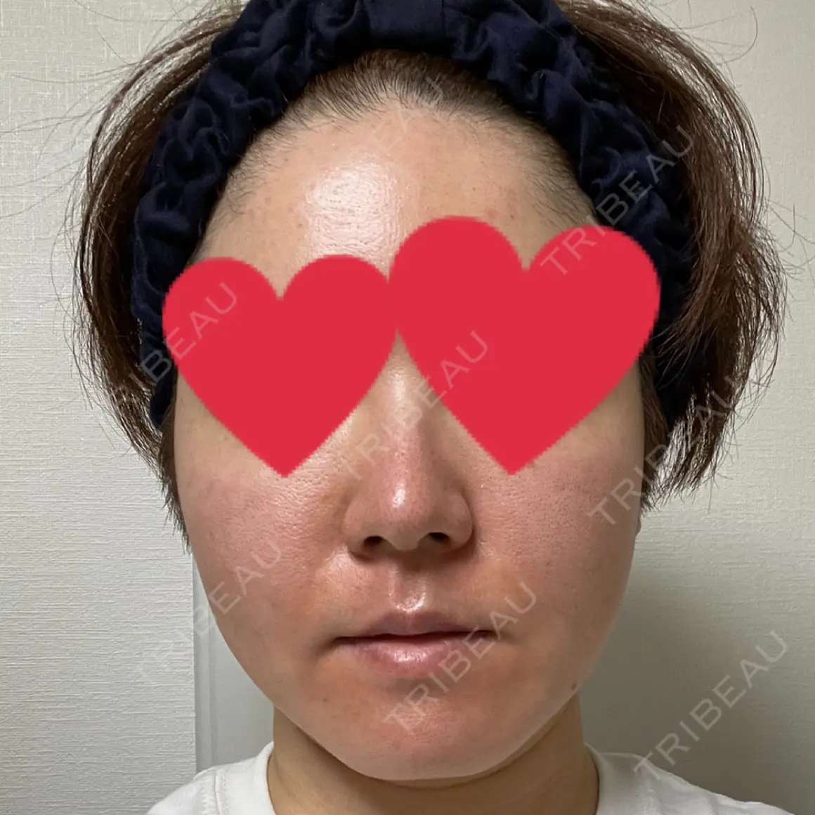 糸リフト / バッカルファット除去 / 脂肪吸引（顔） / 輪郭修正 湘南美容クリニック 秋葉原院 AFTER
