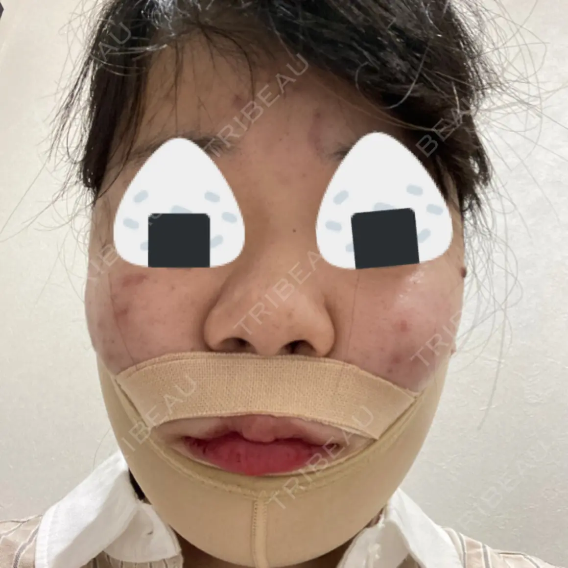 二重埋没 / 骨切り（あご） / バッカルファット除去 / 脂肪吸引（顔） / セットバック / ダーマペン アーククリニック DAY 0