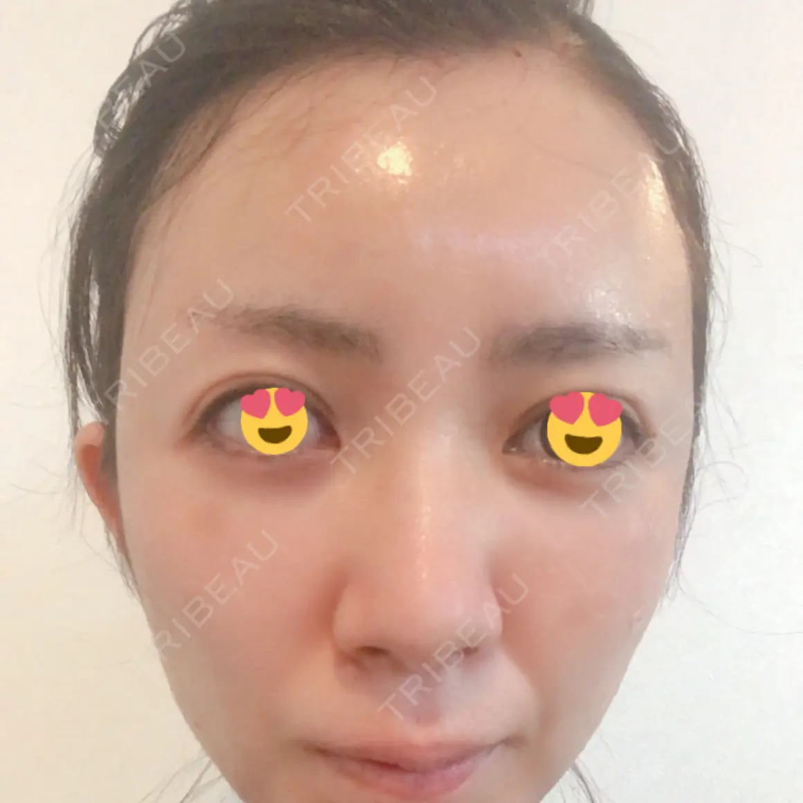 額を丸く / 脂肪注入（肌） / こめかみ形成 / 脂肪注入（額） 湘南美容クリニック 浜松院 DAY 0