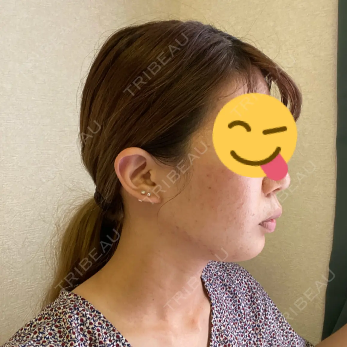 糸リフト / 脂肪吸引（顔） あつぎ美容クリニック AFTER