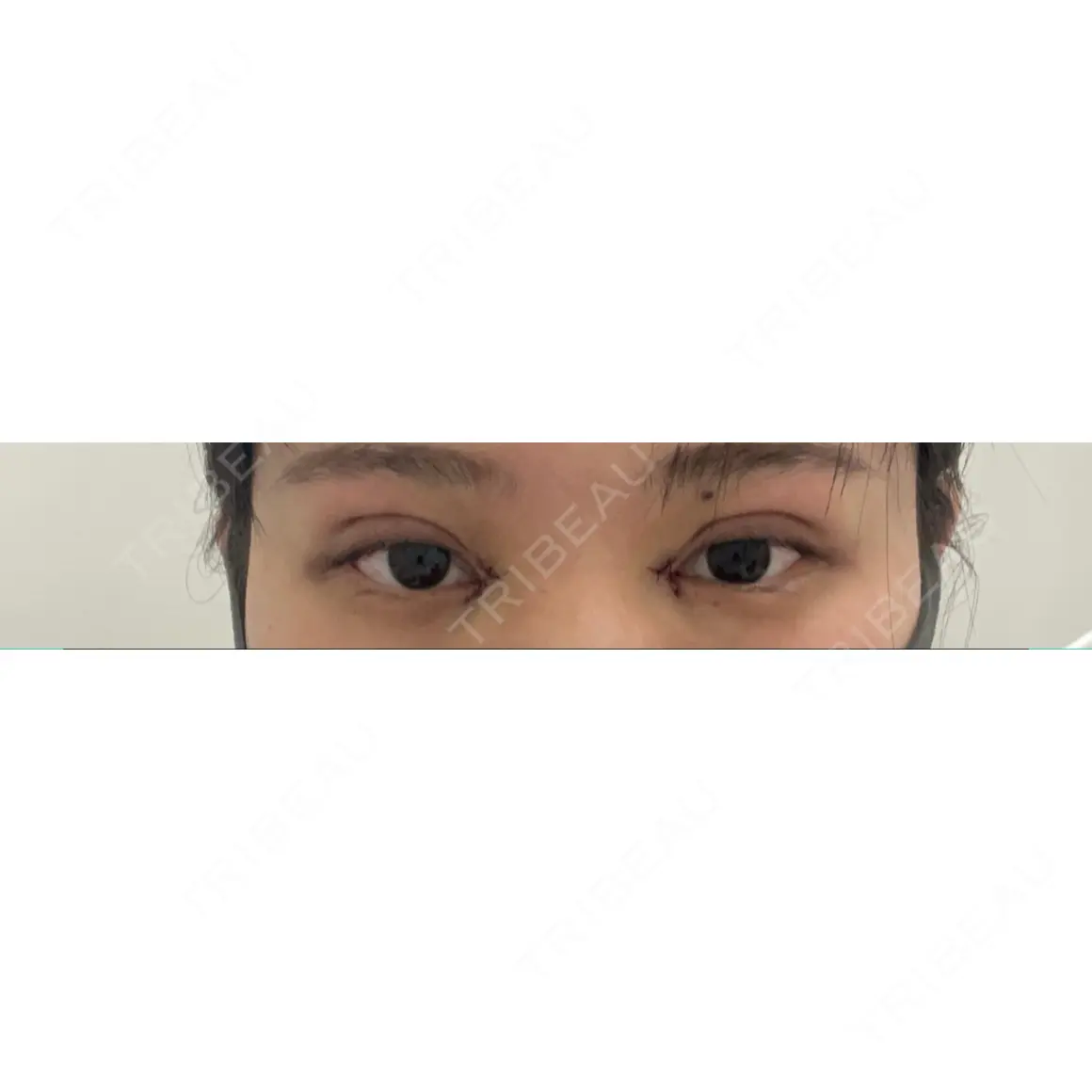 二重埋没 / 目頭切開 TCB東京中央美容外科 新宿東口院 DAY 0