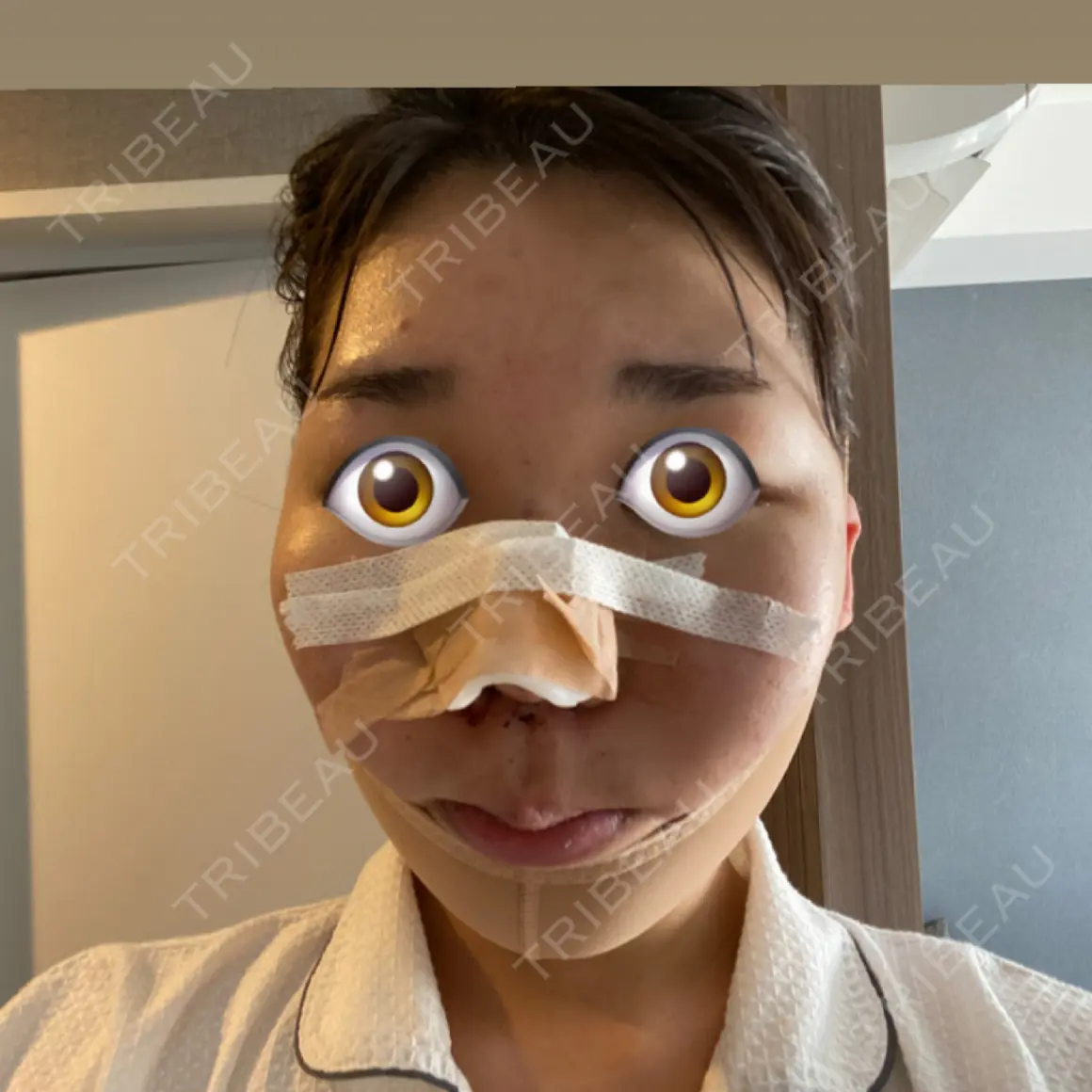 隆鼻術 / 鼻尖形成（切開） / 小鼻縮小（切開） / 脂肪吸引（顔） / 軟骨移植 MIL CLINIC OSAKA DAY 1