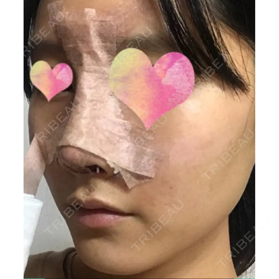 隆鼻術 / 鼻尖形成（切開） / 鼻中隔延長（切開） / 小鼻縮小（切開） / 鼻修正 / その他（鼻） ソウルリスタ整形外科 DAY 3