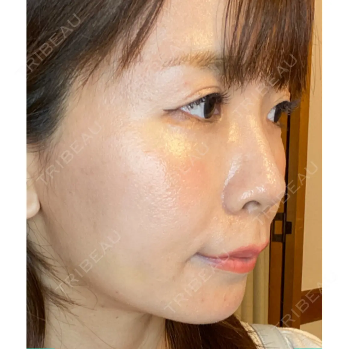 その他（輪郭） 東京ロイヤルクリニック AFTER