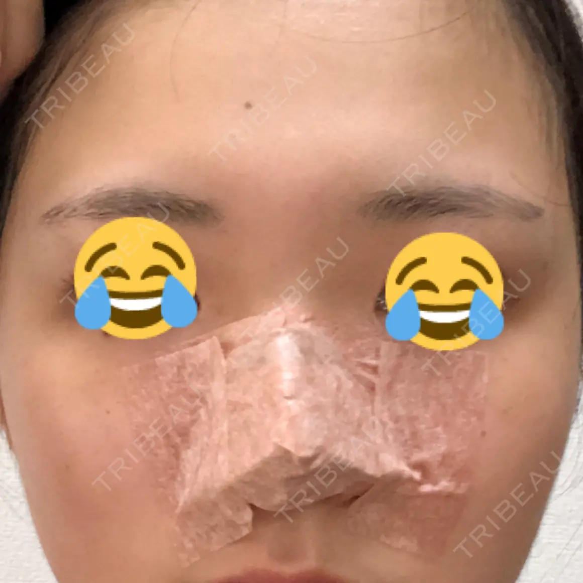 軟骨移植 フェアクリニック川口 DAY 0